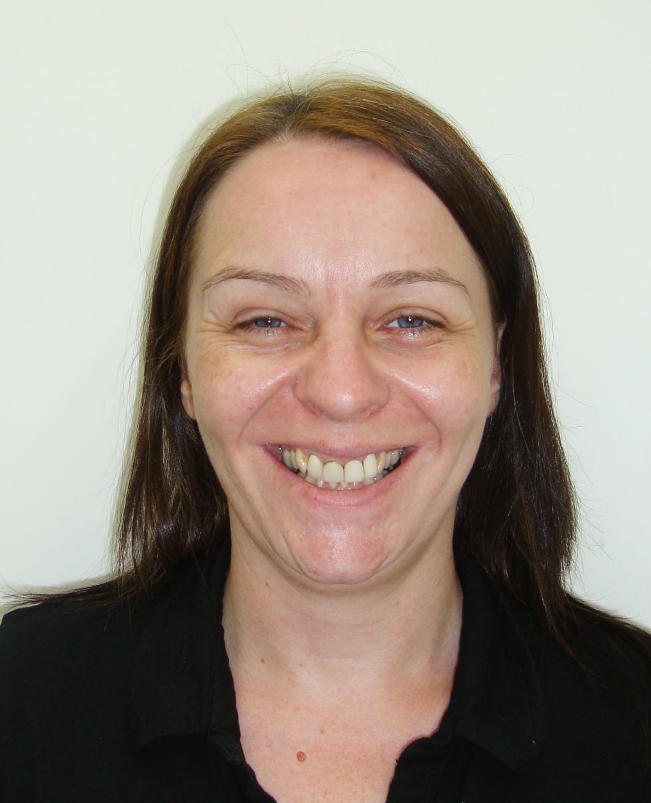 Before - Smile Transformation 1